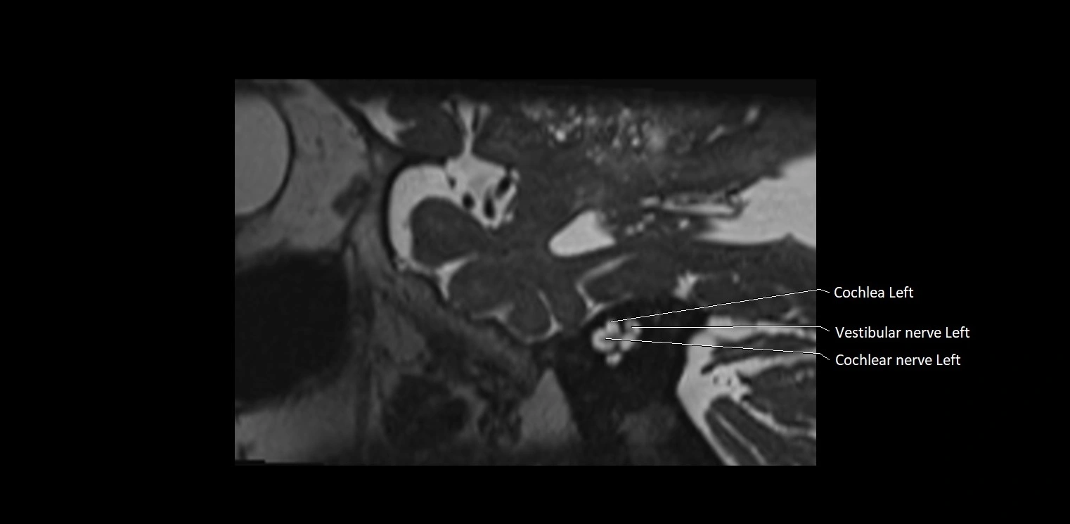 Cranial nerve sagittal anatomy MRI 3T image 8.webp